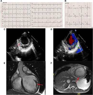 Case report: A rare case of left ventricular noncompaction in two Chinese siblings with becker muscular dystrophy caused by deletion of exons 10 to 12 in the DMD gene